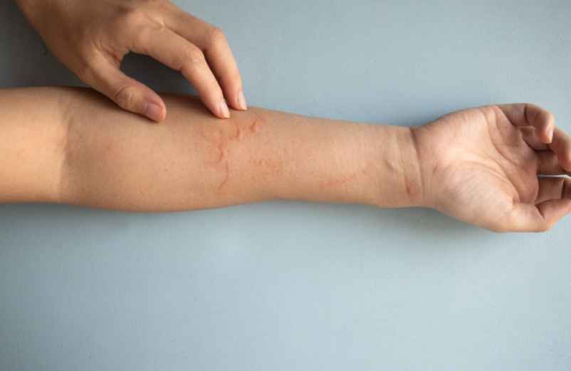 Piqûre d’insecte qui ne disparaît pas : que faire et quand s’inquiéter ? J'amène-le-Dessert