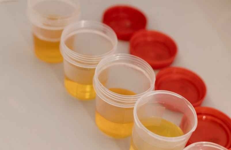 Comment éliminer Escherichia coli dans les urines efficacement et éviter les récidives ? J'amène-le-Dessert