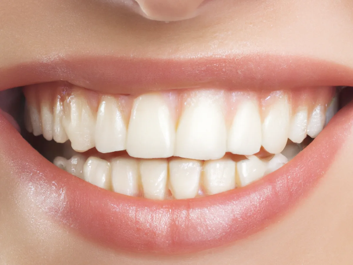 Comparaison visuelle des différentes méthodes de blanchiment dentaire : à la maison, en institut et chez le dentiste